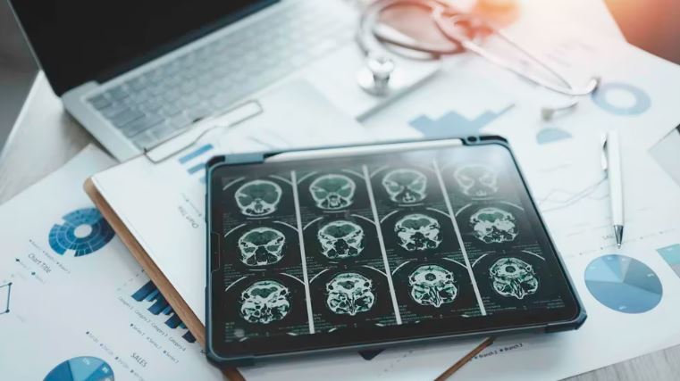 Estados Unidos aprobó el primer fármaco que ralentiza de forma clara el avance del Alzheimer