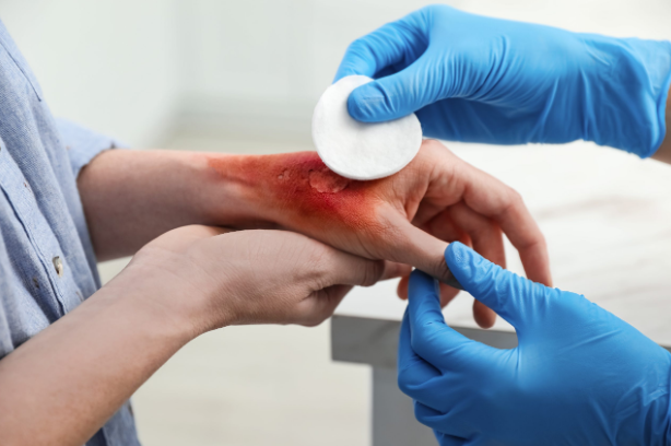 Cifra de menores con quemaduras disminuyó 4% el año pasado en comparación con 2022