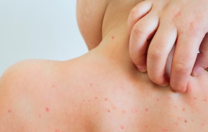 Salud registra en promedio un caso de varicela cada tres horas durante este año