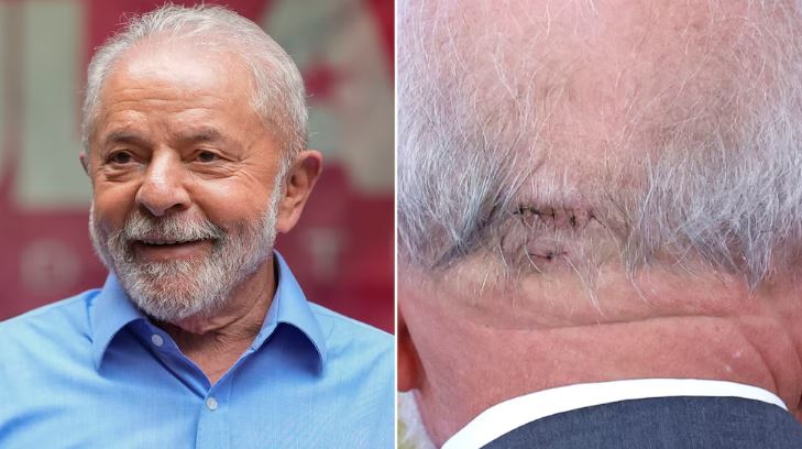 Lula da Silva fue operado de emergencia por una hemorragia intracraneal tras una caída