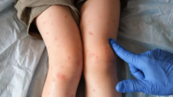 Salud confirma tres casos de sarampión y descarta sospecha en el Liceo de Moravia