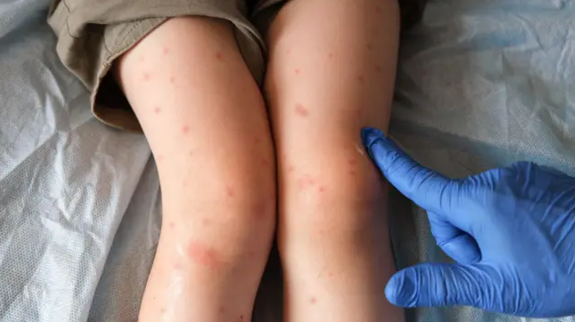 Salud confirma tres casos de sarampión y descarta sospecha en el Liceo de Moravia