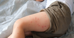 Colegio de Médicos advierte que una persona con sarampión puede contagiar hasta 18 más