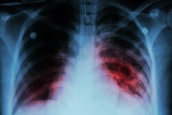Costa Rica registró la cifra más alta de tuberculosis en tres años durante 2025