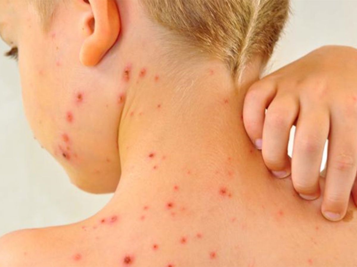 ¿Cuál es el panorama del país tras los cinco casos de sarampión este año?